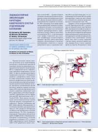 Кузнецовэндоваскулярная эмболизация каротидно-кавернозного соустья отделяемыми баллонами