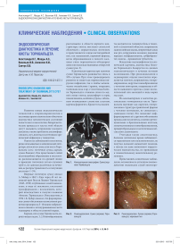 Эндоскопическая диагностика и лечение кисты Торнвальдта