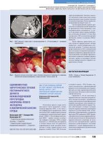Одномоментное хирургическое лечение постинфарктного дефекта межжелудочковой перегородки, аневризмы левого желудочка и ишемической болезни сердца