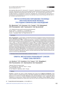 Метастатическое поражение глазницы при раке молочной железы: три редких клинических наблюдения