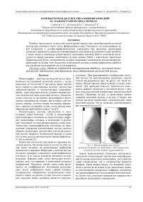 Компьютерная диагностика новообразований на маммографических снимках