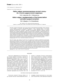 Hallux valgus: рентгенометрия костей стопы до и после хирургической коррекции