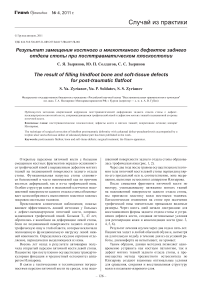 Результат замещения костного и мягкотканого дефектов заднего отдела стопы при посттравматическом плоскостопии