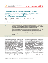 Эпикардиальная аблация желудочковой экстрасистолии из выходного отдела правого желудочка после неэффективной эндокардиальной аблации