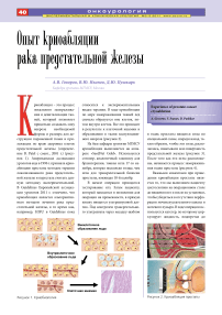 Опыт криоабляции рака предстательной железы