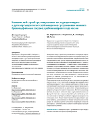 Клинический случай протезирования восходящего отдела и дуги аорты при гигантской аневризме с устранением кинкинга брахиоцефальных сосудов у ребенка первого года жизни