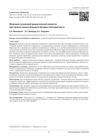 Фиксация сухожилий вращательной манжеты при полном лизисе большого бугорка плечевой кости