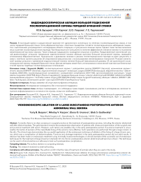 Видеэндоскопическая абляция большой подкожной послеоперационной серомы передней брюшной стенки
