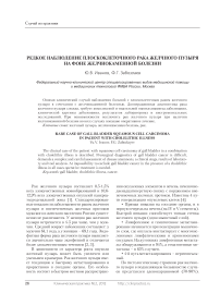 Редкое наблюдение плоскоклеточного рака желчного пузыря на фоне желчнокаменной болезни