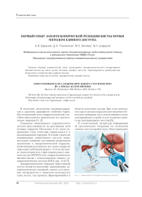 Первый опыт лапароскопической резекция кисты почки методом единого доступа