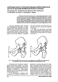 Коррекция вальгусной деформации шейки бедренной кости по данным биомеханического анализа