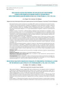 Высокопольная магнитно-резонансная томография в визуализации вазоневрального конфликта при тригеминальной невралгии (на томографах 1,5 и 3 тесла)