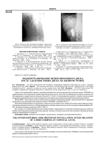 Эндопротезирование межпозвоночного диска послеудаления грыжи диска на шейном уровне