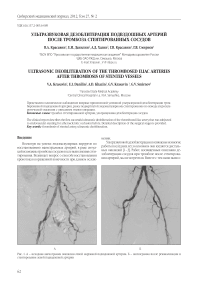 Ультразвуковая дезоблитерация подвздошных артерий после тромбоза стентированных сосудов