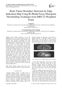 Brain Tumor Boundary Detection by Edge Indication Map Using Bi-Modal Fuzzy Histogram Thresholding Technique from MRI T2-Weighted Scans