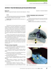 Экспресс-трансгингивальная дентальная имплантация